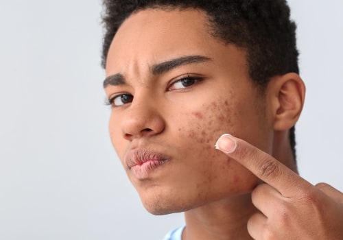 The Natural Way to Clear Acne and Blemishes